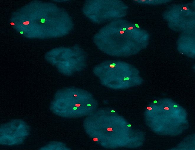 熒光原位雜交(FISH)技術(shù)在臨床中的應(yīng)用