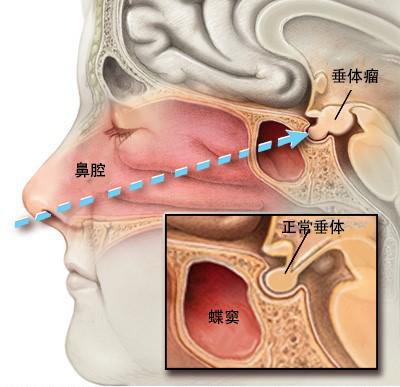 垂體瘤