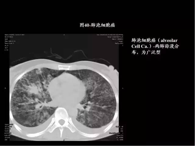 為什么做胸、腹部CT掃描時需要吸氣-屏氣-吐氣？